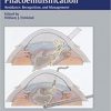 Complications in Phacoemulsification Avoidance Recognition and Management