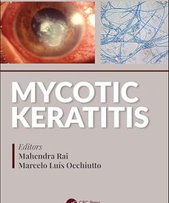 Mycotic Keratitis