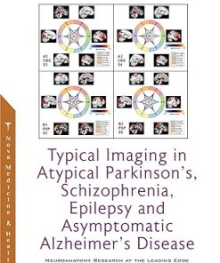 Typical Imaging In Atypical Parkinsons Schizophrenia Epilepsy And Asymptomatic Alzheimers Disease